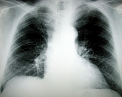 lungs xray morguefile